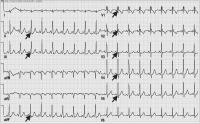 Abbildung 1: Paroxysmale Tachyarrhythmie