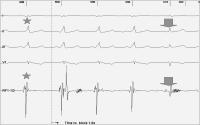 Abbildung 2: Paroxysmale Tachyarrhythmie