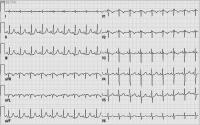 Abbildung 3: Paroxysmale Tachyarrhythmie