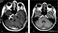 Abbildung 3a-b: Akustikusneurinom - Planungs-MRT für Gamma Knife