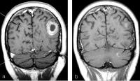 Abbildung 4a-b: Hirnmetastase - Planungs-MRT für Gamma Knife