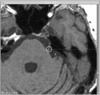 Abbildung 6: Gamma Knife - Dosisplan