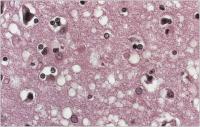 Abbildung 1: Spongiforme Enzephalopathie