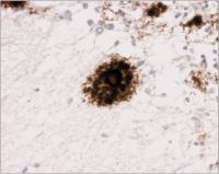 Abbildung 4: Spongiforme Enzaphalopathie - GSS - Prionprotein