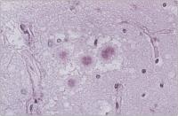 Abbildung 7: Spongiforme Enzephalopathie - vCJK - Prionprotein