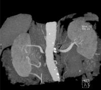 Abbildung 1: Arteria renalis sinistra proximal - Thrombus