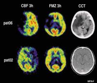 Abbildung 8: Gehirn - Perfusion