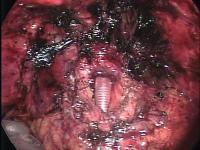 Abbildung 4: Prostatakarzinom - Chirurgie