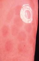 Abbildung 1: Testosteronpflaster - Dermatitis