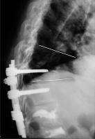 Abbildung 3-c: Kyphoplastie - Augmentationstechnik