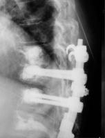 Abbildung 3-e: Kyphoplastie - Augmentationstechnik
