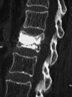 Abbildung 4-c: Zementverteilung - Postoperativ