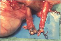 Abbildung 3: Vasovasostomie