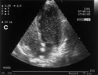 Abbildung 3c: Hepatopulmonales Syndrom - Fallbericht