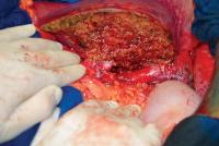 Abbildung 7: Lebertransplantation - Empfängeroperation