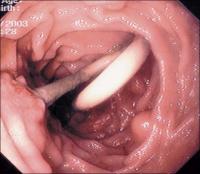 Abbildung 2: Pigtail-Prothese - Papilla Vateri