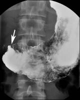 Abbildung 1: Morbus Crohn - Duodenum