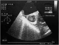 Abbildung 3-a: Vena cava sup. - Subtotale Thrombose