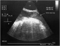 Abbildung 3-b: Vena cava sup. - Subtotale Thrombose