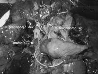 Abbildung 6-b: Flottierender Thrombus