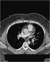 Abbildung 2: Zentrale Pulmonalembolie