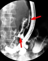 Abbildung 1: Fistel vom D. pancreaticus in die Bursa omentalis reichend