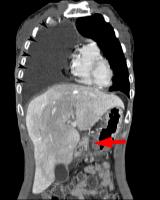Abbildung 2b: Coronale MDCT-Rekonstruktion der Fistel