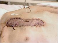 Abbildung 3: Musculus-pectorialis-Lappen