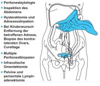 Abbildung 1: Ovarialkarzinom