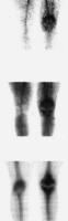 Abbildung 1: Osteomyelitis