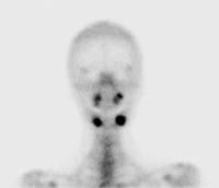Abbildung 2: Osteomyelitis