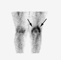 Abbildung 3: Osteomyelitis