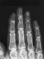 Abbildung 1: Osteoporose - Radiologie