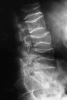 Abbildung 4: Osteoporose - Radiologie