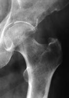 Abbildung 5: Osteoporose - Radiologie