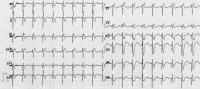 Abbildung 1: 12-Ableitungs-EKG