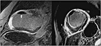 Abbildung 4: MR - Perikard - Thrombus