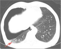 Abbildung 2a: Pneumothorax