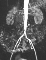 Abbildung 1: Aortenbifurkationsstenose - Stenose der Arteria iliaca communis