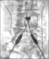 Abbildung 4: Kissing-Stenting
