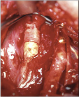 Abbildung 2c: Arteria carotis communis