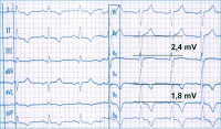 Abbildung 1: Hypertrophie - EKG