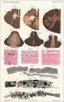 Abbildung 1: Multiple Sklerose - Pathologie