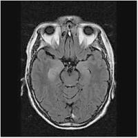 Abbildung 1: Nichtneoplastische limbische Enzephalitis