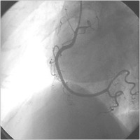 Abbildung 2b: Angiogramm - Koronararterie