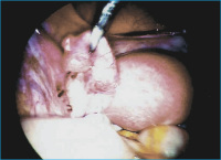 Abbildung 1: Ectopic pregnancy