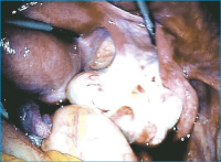 Abbildung 2: Contralateral right tube