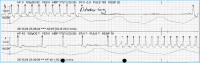 Abbildung 2: EKG - Tachykardie