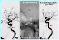 Abbildung 1: A. carotis interna - Stent