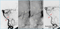 Abbildung 3: A. basilaris - Stent